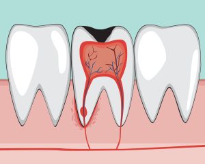 Tipos de pulpitis: reversible e irreversible