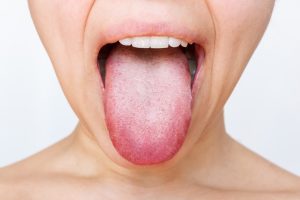 ¿Por qué tengo la lengua blanca? Causas y remedios